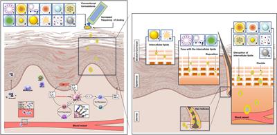 Exploration of and insights into advanced topical nanocarrier systems for the treatment of psoriasis